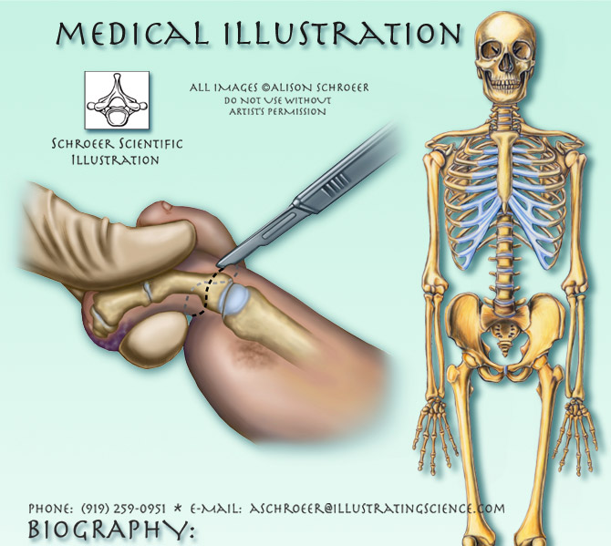 Biography-Alison-Schroeer-skeleton-amputation-illustration