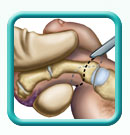 Thumb-toe-amputation-surgery-image